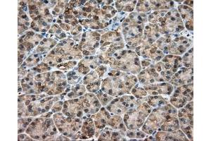 Immunohistochemical staining of paraffin-embedded Adenocarcinoma of colon tissue using anti-RDH11 mouse monoclonal antibody. (RDH11 anticorps)