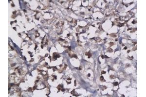 Formalin-fixed and paraffin embedded human breast cancer tissue labeled with Anti-LYVE-1 Polyclonal Antibody, Unconjugated (ABIN674799) followed by conjugation to the secondary antibody and DAB staining (LYVE1 anticorps  (AA 231-318))