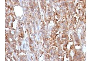 Formalin-fixed, paraffin-embedded human cervical carcinoma stained with Beta-2-Microglobulin antibody.