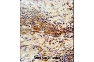 DNAJC11 antibody (N-term) (ABIN654437 and ABIN2844172) immunohistochemistry analysis in formalin fixed and paraffin embedded human lung carcinoma followed by peroxidase conjugation of the secondary antibody and DAB staining. (DNAJC11 anticorps  (N-Term))