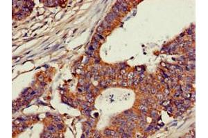 Immunohistochemistry of paraffin-embedded human colon cancer using ABIN7147600 at dilution of 1:100