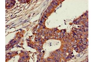 Immunohistochemistry of paraffin-embedded human colon cancer using ABIN7147600 at dilution of 1:100 (CH25H anticorps  (AA 142-272))