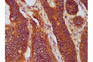 IHC image of ABIN7170318 diluted at 1:400 and staining in paraffin-embedded human colon cancer performed on a Leica BondTM system. (SOS1 anticorps  (AA 1140-1281))