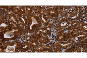 Immunohistochemistry of paraffin-embedded Human thyroid cancer tissue using KLHL1 Polyclonal Antibody at dilution 1:30 (KLHL1 anticorps)