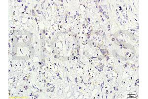 Formalin-fixed and paraffin-embedded human cervical carcinoma labeled with Rabbit Anti-CD160/By55 Polyclonal Antibody (ABIN741555), Unconjugated at 1:200 followed by conjugation to the secondary antibody and DAB staining. (CD160 anticorps  (AA 81-159))