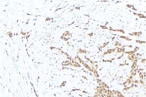 ABIN6276330 at 1/100 staining Human lung cancer tissue by IHC-P.