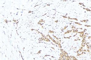 ABIN6276330 at 1/100 staining Human lung cancer tissue by IHC-P. (MTM1 anticorps  (C-Term))