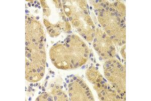 Immunohistochemistry of paraffin-embedded Human gastric using AKT1 antibody at dilution of 1:100 (x400 lens). (AKT1 anticorps)