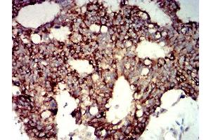 Immunohistochemical analysis of paraffin-embedded colon cancer tissues using P2RY14 mouse mAb with DAB staining. (P2RY14 anticorps)