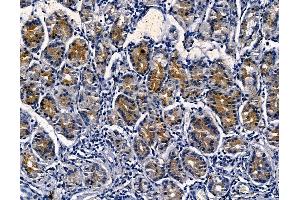 SPNS1 Antibody at 1/100 staining human pancreatic cancer and adjacent non-tumor tissue by IHC-P. (SPNS1/Spinster 1 anticorps)