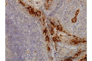 Immunoperoxidase of monoclonal antibody to TNFRSF6B on formalin-fixed paraffin-embedded human tonsil.