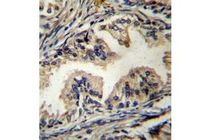 Formalin fixed, paraffin embedded human prostate carcinoma stained with STAMBP Antibody (C-term) followed by peroxidase conjugation of the secondary antibody and DAB staining.