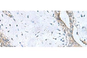 Immunohistochemistry of paraffin-embedded Human breast cancer tissue using PPIC Polyclonal Antibody at dilution of 1:50(x200)