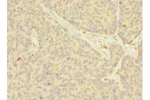 Immunohistochemistry of paraffin-embedded human ovarian cancer using ABIN7161035 at dilution of 1:100 (NANOS2 anticorps  (AA 1-138))