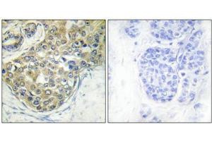 Immunohistochemical analysis of paraffin-embedded human breast carcinoma tissue using ACK1 (Phospho-Tyr284) antibody (left)or the same antibody preincubated with blocking peptide (right). (TNK2 anticorps  (pTyr284))