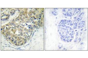 Immunohistochemical analysis of paraffin-embedded human breast carcinoma tissue using ACK1 (Phospho-Tyr284) antibody (left)or the same antibody preincubated with blocking peptide (right).
