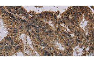 Immunohistochemistry of paraffin-embedded Human colon cancer using Histone H4 Polyclonal Antibody at dilution of 1:30 (Histone H4 anticorps)