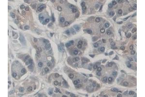 Detection of CD300c in Human Pancreatic cancer Tissue using Polyclonal Antibody to CD300 Antigen Like Family Member C (CD300c) (CD300c anticorps  (AA 21-183))