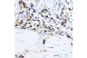 Immunohistochemistry of paraffin-embedded human esophageal cancer using LCK Rabbit pAb (ABIN3023129, ABIN3023130, ABIN3023131 and ABIN6219404) at dilution of 1:100 (40x lens).