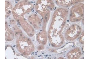 DAB staining on IHC-P; Samples: Human Glioma Tissue (Interferon gamma anticorps  (AA 24-166))