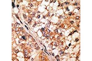 IHC analysis of FFPE human hepatocarcinoma tissue stained with the Bim antibody