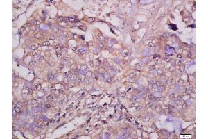 Formalin-fixed and paraffin embedded human lung carcinoma tissue labeled with Anti-MCSF Polyclonal Antibody, Unconjugated 1:400 followed by conjugation to the secondary antibody and DAB staining. (M-CSF/CSF1 anticorps  (AA 201-300))