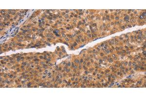 Immunohistochemistry of paraffin-embedded Human liver cancer tissue using NCAPG2 Polyclonal Antibody at dilution 1:50 (NCAPG2 anticorps)