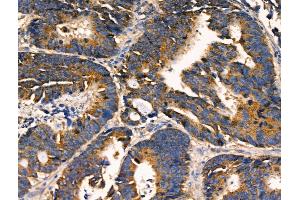 ABIN6256896 and ABIN6274454 at 1/100 staining Human colorectal cancer by IHC-P. (AKAP1 anticorps  (Internal Region))