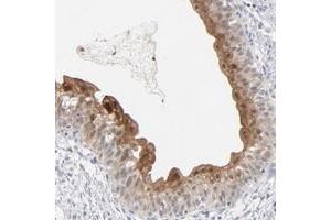 Immunohistochemical staining of human urinary bladder with POF1B polyclonal antibody  shows moderate nuclear and cytoplasmic positivity in urothelial cells at 1:50-1:200 dilution.