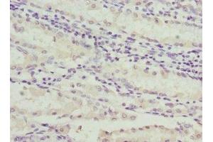 Immunohistochemistry of paraffin-embedded human gastric cancer using ABIN7146153 at dilution of 1:100