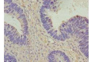 Immunohistochemistry of paraffin-embedded human ovarian cancer using ABIN7175357 at dilution of 1:100 (Vangl1 anticorps  (AA 275-524))