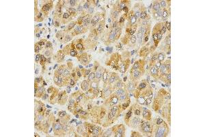 Immunohistochemistry of paraffin-embedded human liver cancer using TPM2 antibody.