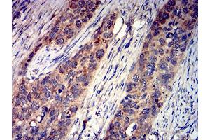 Immunohistochemical analysis of paraffin-embedded cervical cancer tissues using GRIK4 mouse mAb with DAB staining.