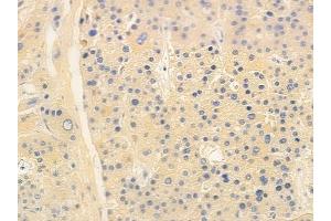 ABIN6261744 and ABIN6266778 at 1/100 staining human hepatocellular carcinoma by IHC-P.