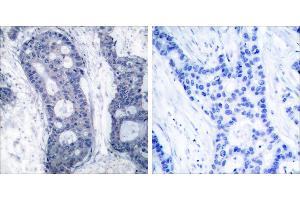 Peptide - +Immunohistochemical analysis of paraffin-embedded human breast carcinoma tissue using elF4E (Ab-209) antibody (#B7067). (EIF4E anticorps  (Ser209))