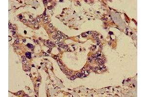 Immunohistochemistry of paraffin-embedded human pancreatic cancer using ABIN7143291 at dilution of 1:100