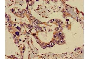 Immunohistochemistry of paraffin-embedded human pancreatic cancer using ABIN7143291 at dilution of 1:100 (ADK anticorps  (AA 18-256))
