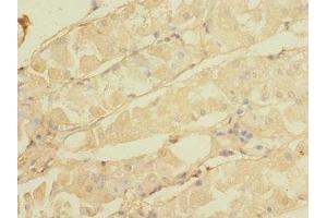 Immunohistochemistry of paraffin-embedded human gastric cancer using ABIN7146298 at dilution of 1:100 (CALHM3 anticorps  (AA 201-350))