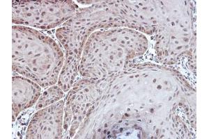 IHC-P Image Immunohistochemical analysis of paraffin-embedded Cal27 xenograft, using Aspartoacylase, antibody at 1:100 dilution. (ASPA anticorps)