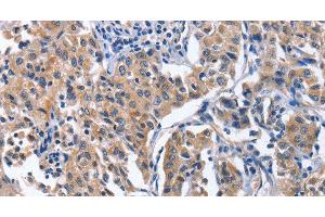 Immunohistochemistry of paraffin-embedded Human lung cancer tissue using INTS10 Polyclonal Antibody at dilution 1:50