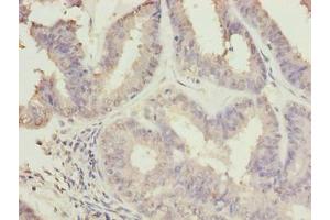 Immunohistochemistry of paraffin-embedded human endometrial cancer using ABIN7174707 at dilution of 1:100 (RPAP2 anticorps  (AA 1-154))