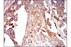 Immunohistochemical analysis of paraffin-embedded ovarian cancer tissues using SDC1 mouse mAb with DAB staining. (Syndecan 1 anticorps  (AA 28-171))