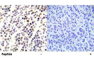 Immunohistochemical analysis of paraffin-embedded human malignant lymphoma tissue using HIST1H3E (phospho S28) polyclonal antibody . (HIST1H3E anticorps  (pSer28))