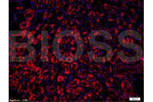 Formalin-fixed and paraffin-embedded : human gastric adenocarcinoma labeled with Rabbit Anti-VPS18 Polyclonal Antibody (ABIN675833), Unconjugated 1:200followed by conjugation to the PE secondary antibody