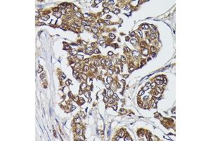 Immunohistochemistry of paraffin-embedded human breast cancer using FERMT2 Rabbit pAb (ABIN6131926, ABIN6140582, ABIN6140583 and ABIN6224757) at dilution of 1:300 (40x lens).