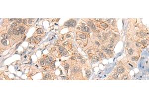 Immunohistochemistry of paraffin-embedded Human esophagus cancer tissue using GPR55 Polyclonal Antibody at dilution of 1:40(x200) (GPR55 anticorps)