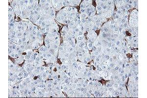 Immunohistochemical staining of paraffin-embedded Carcinoma of Human liver tissue using anti-BCAT1 mouse monoclonal antibody. (BCAT1 anticorps)
