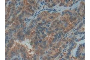 Detection of PDGF BB in Human Thyroid cancer Tissue using Polyclonal Antibody to Platelet Derived Growth Factor BB (PDGF BB) (PDGF-BB Homodimer (AA 82-190) anticorps)