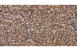 Immunohistochemistry of paraffin-embedded Human sarcoma using KIF1C Polyclonal Antibody at dilution of 1:60 (KIF1C anticorps)
