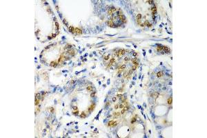 Immunohistochemistry of paraffin-embedded human colon carcinoma using CRYAA antibody (ABIN5973354) at dilution of 1/200 (40x lens). (CRYAA anticorps)